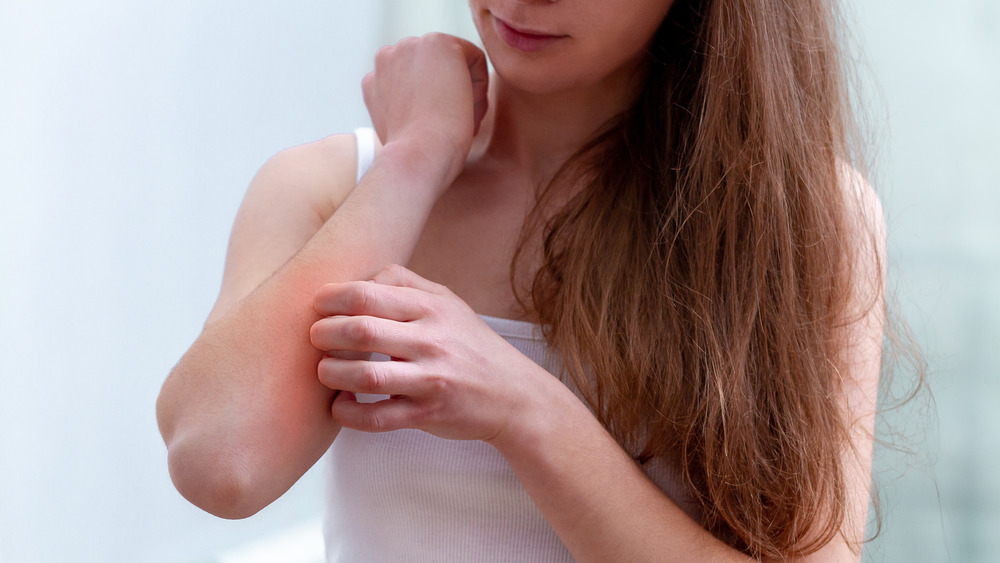 woman scratching mosquito bite on arm