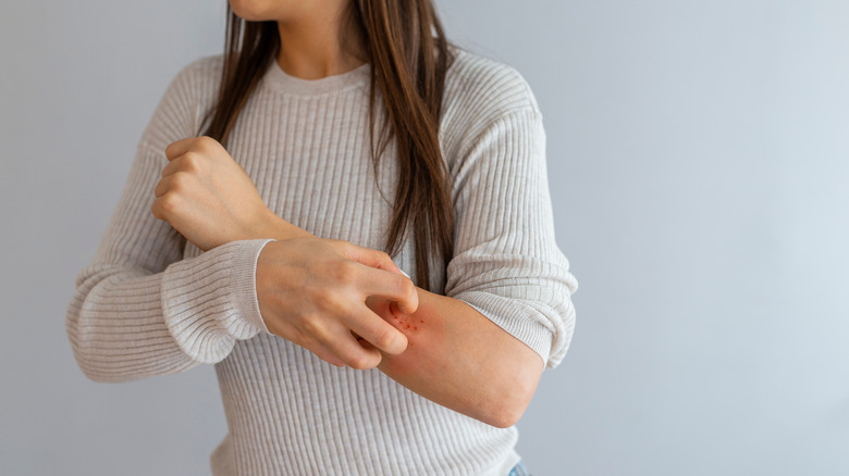 Woman scratching rash on arm 