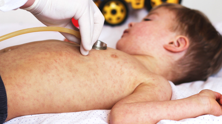 young boy with measles 