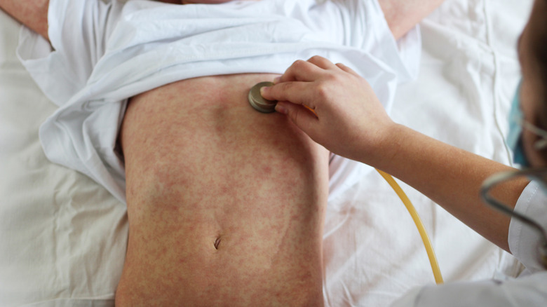 doctor assisting measles patient