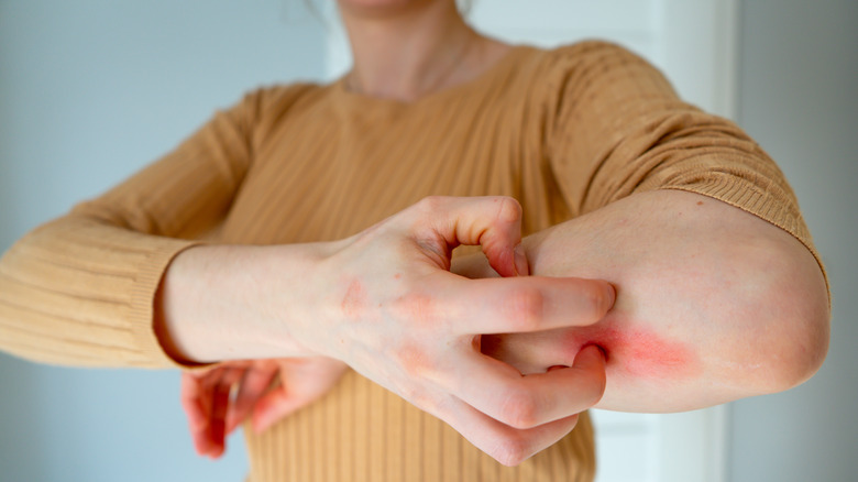 woman scratching rash on elbow