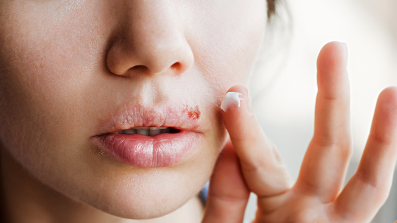 Person with cold sore on lip