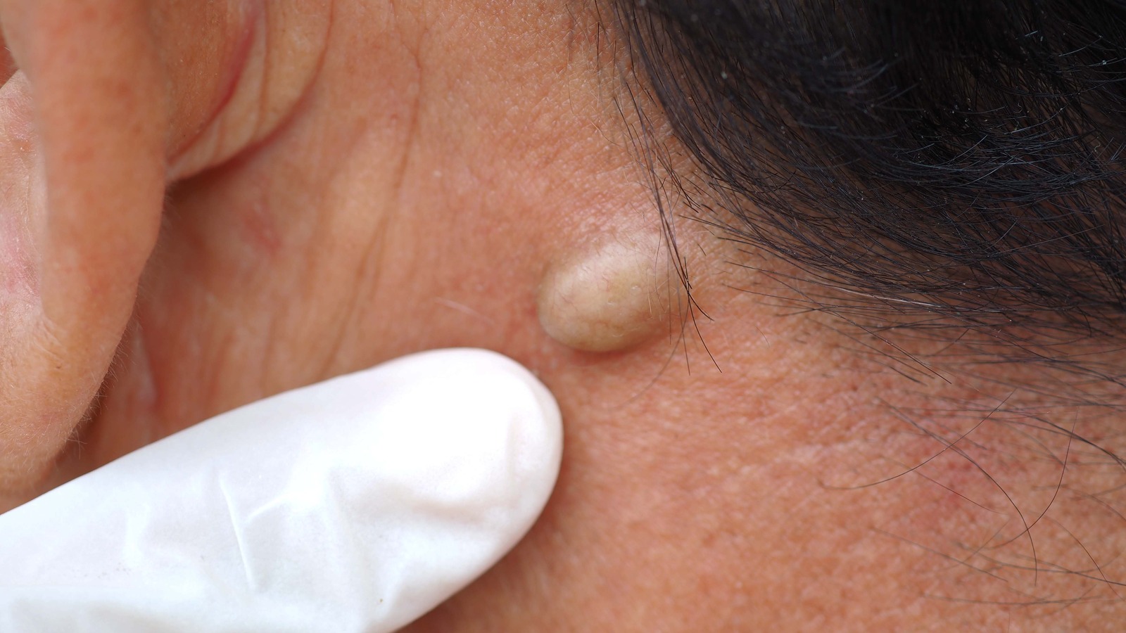 Sebaceous Cyst Face Removal