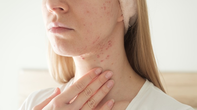 woman with cystic acne scars 