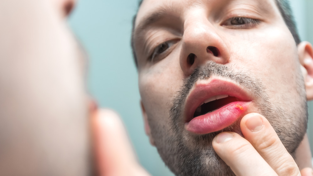 Close up of man looking in mirror with cold sore on his lip
