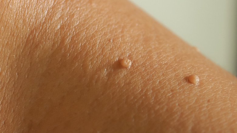 Skin tags