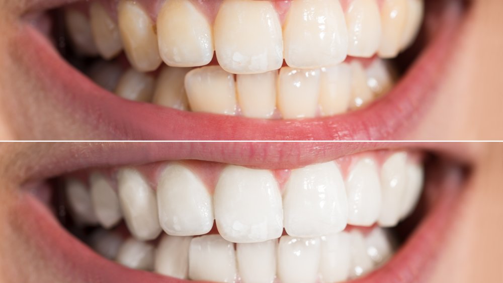 Teeth whitening