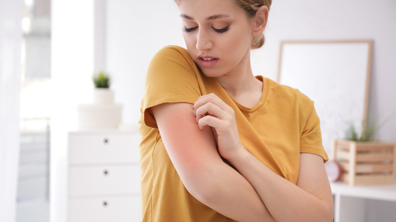 young woman scratching her red and swollen upper arm