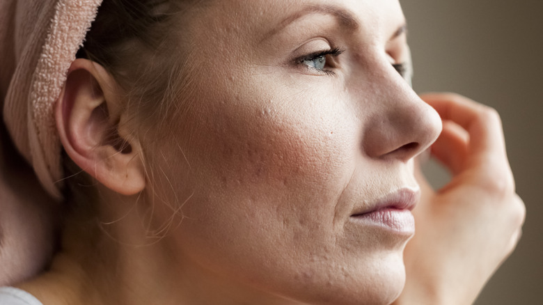 woman with acne scars