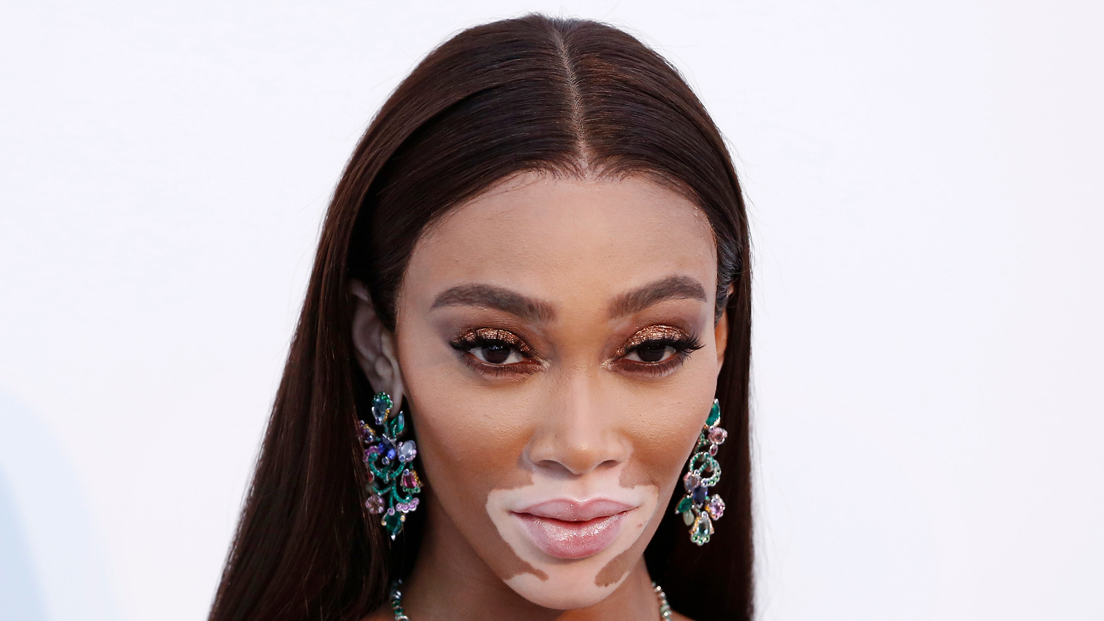 Winnie Harlow's Skin Condition Explained