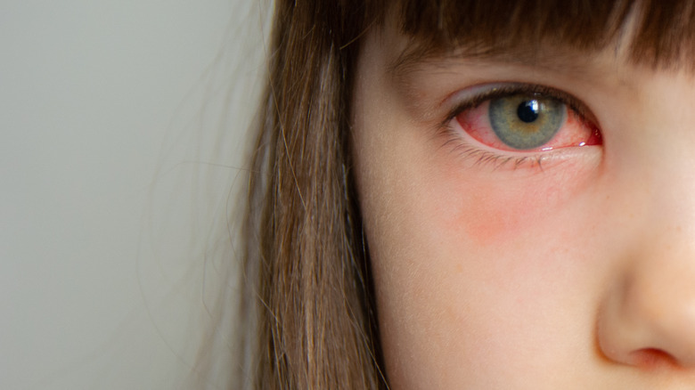 a little girl with red eyes, pink eye