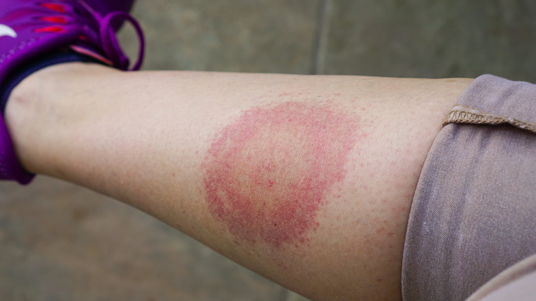 Bulls-eye rash on lower leg