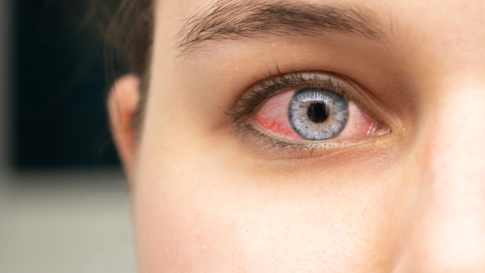 You Might Have Pink Eye If This Happens To You
