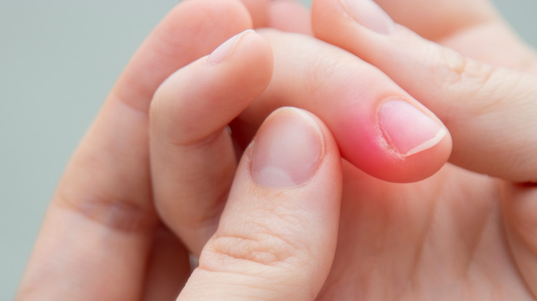 irritated fingernail 